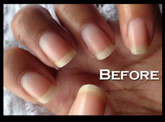 Peeling Nails Becky-Before