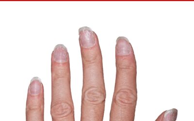 Quick Tips: Why are my nails suddenly breaking, brittle, peeling?