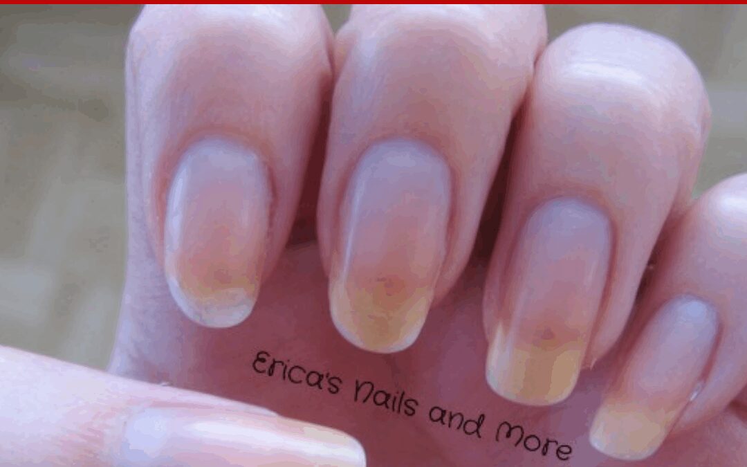 YELLOW NAILS & NAIL OIL  – Pure Nail Oil™ Challenger Erica’s Results