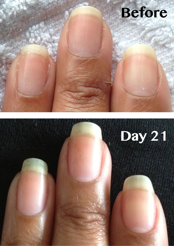 Peeling Nails www.NailCareHQ.com Becky's before and after