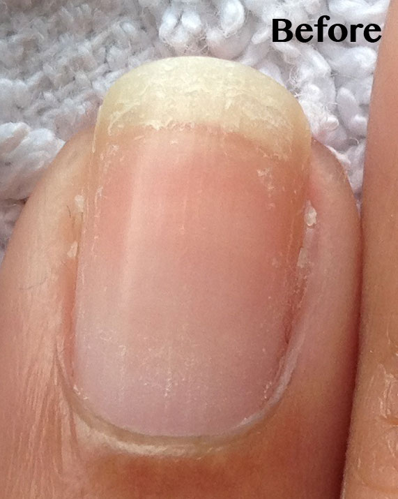 Peeling-nails-Becky-Before-Closeup www.NailCareHQ.com