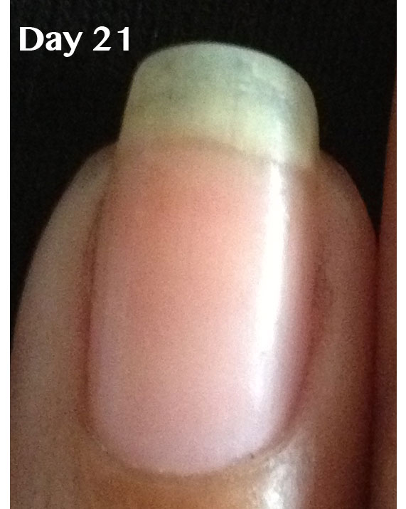 Peeling-nails-Becky-Before-Closeup www.NailCareHQ.com