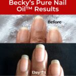 Peeling-nails-Becky-Before-Closeup www.NailCareHQ.com