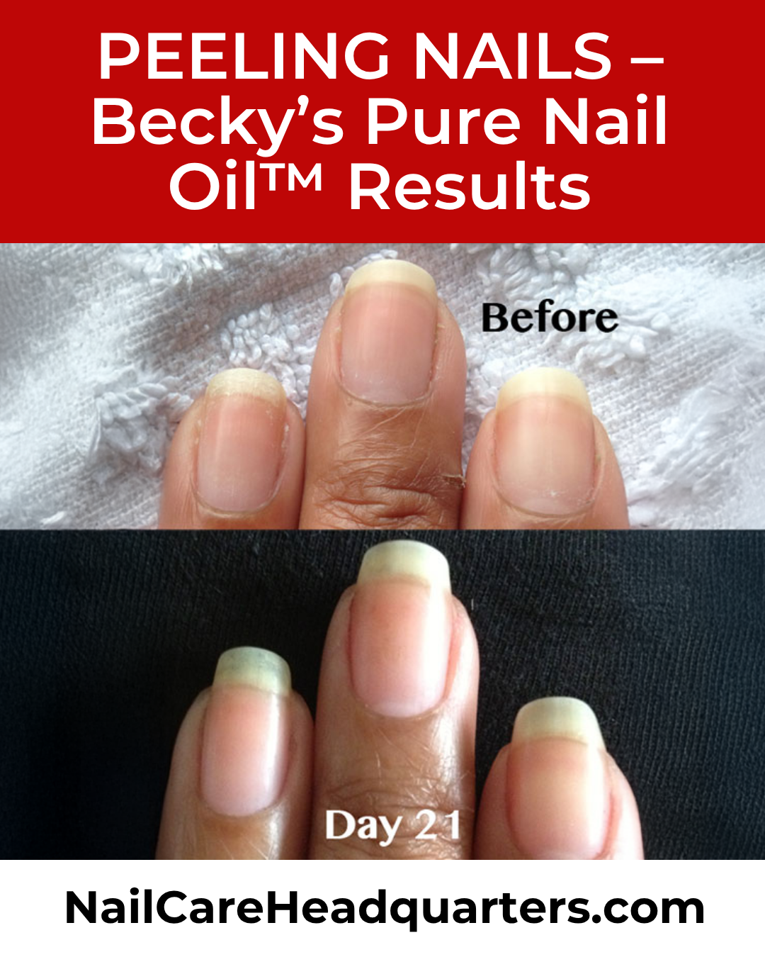 Peeling-nails-Becky-Before-Closeup www.NailCareHQ.com