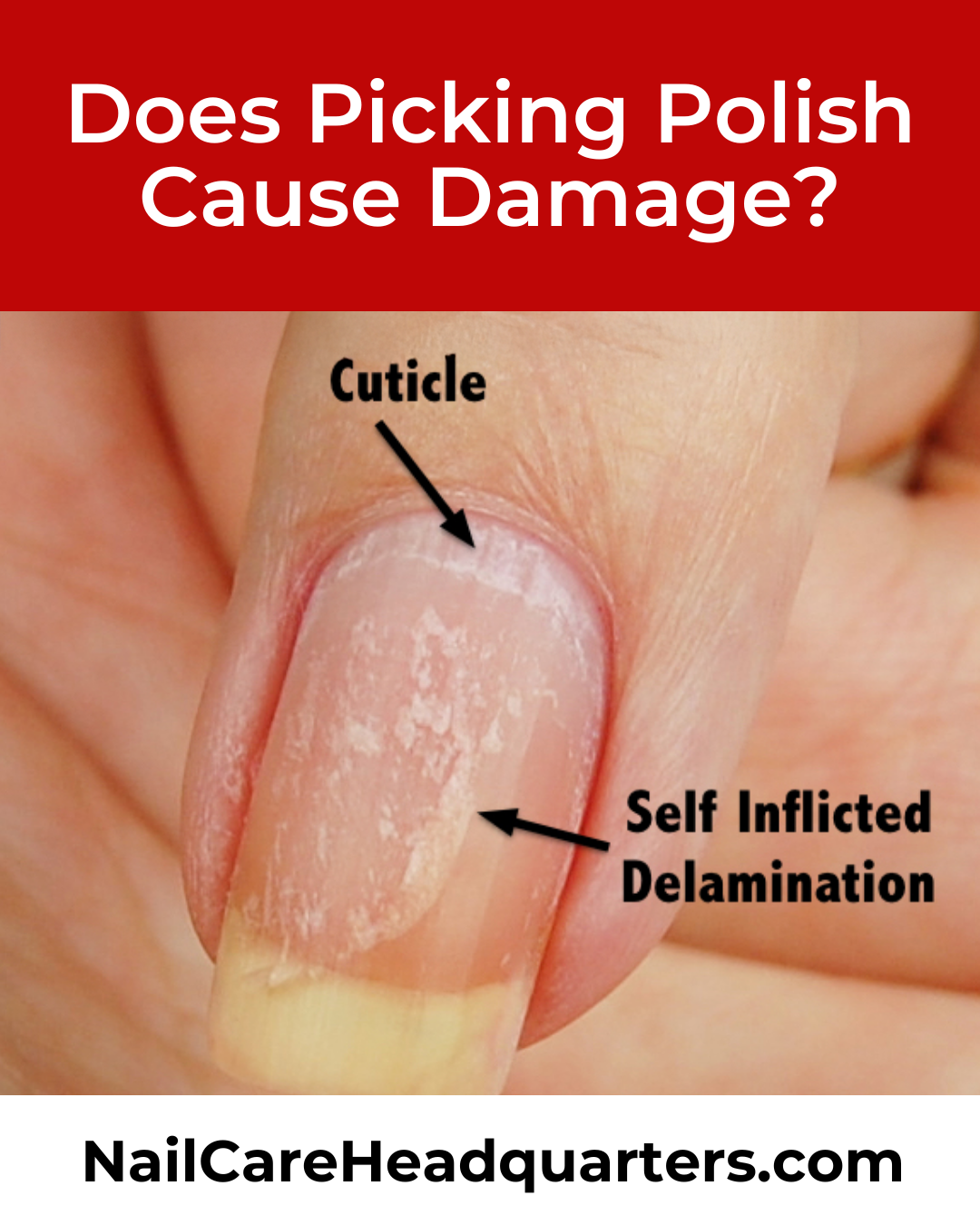 picking-polish-damage-nailcarehq-1 picking-polish-damage-nailcarehq-1