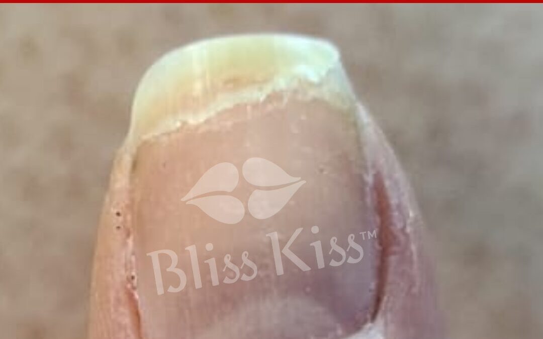 Stress Fractures In Nails