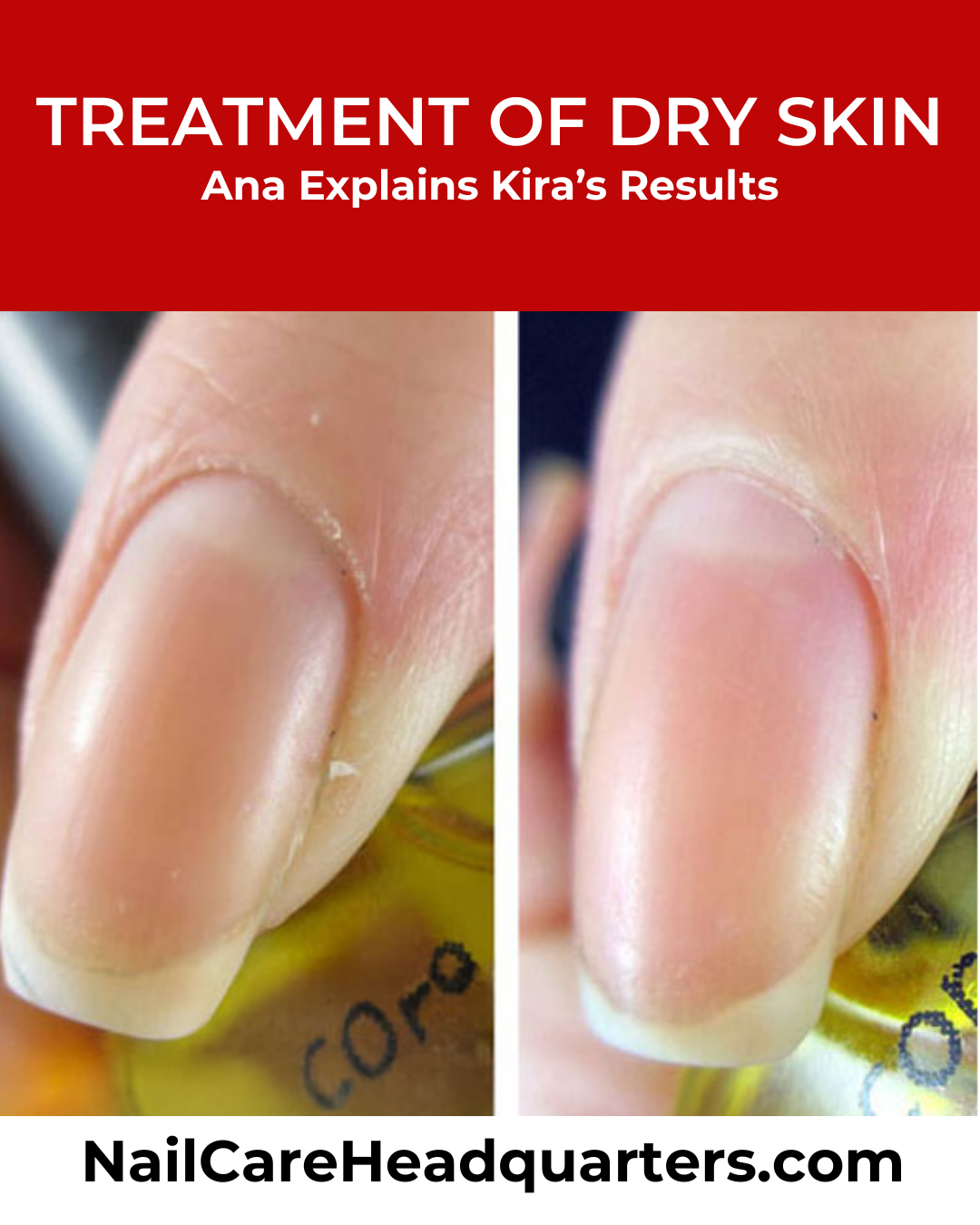 Treatment-of-Dry-Skin-Kira_th