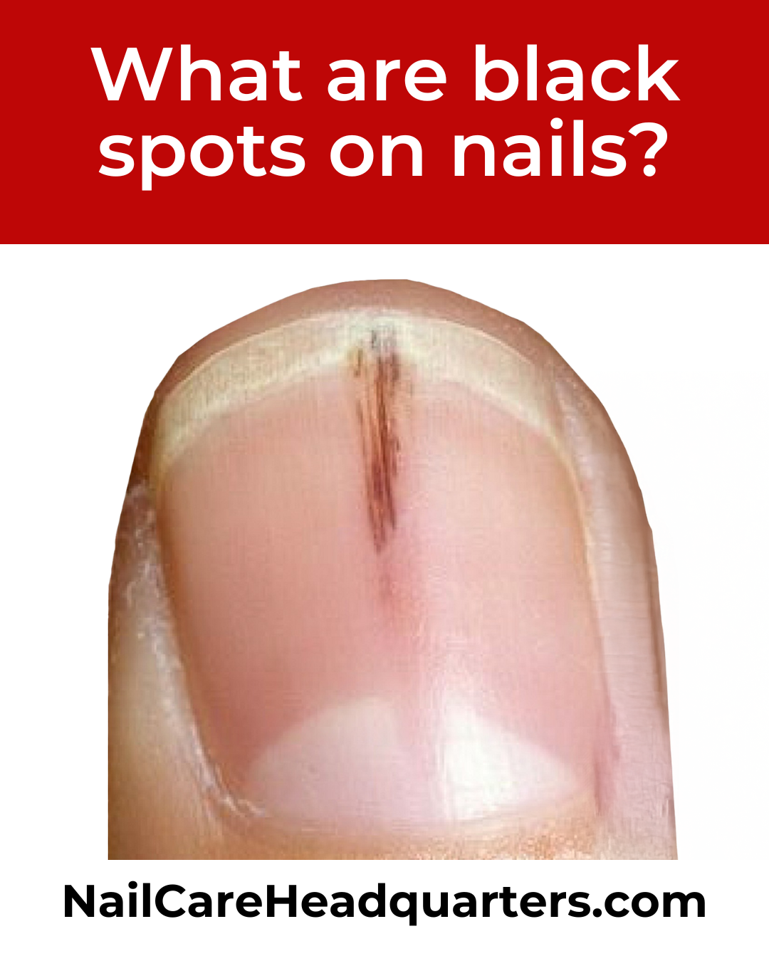 Black Nail Spots?