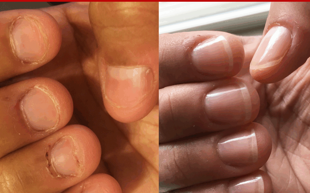 How To Stop Biting Nails – Angela’s Results