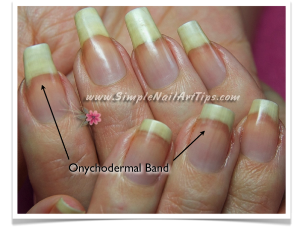 nail separating from nail bed