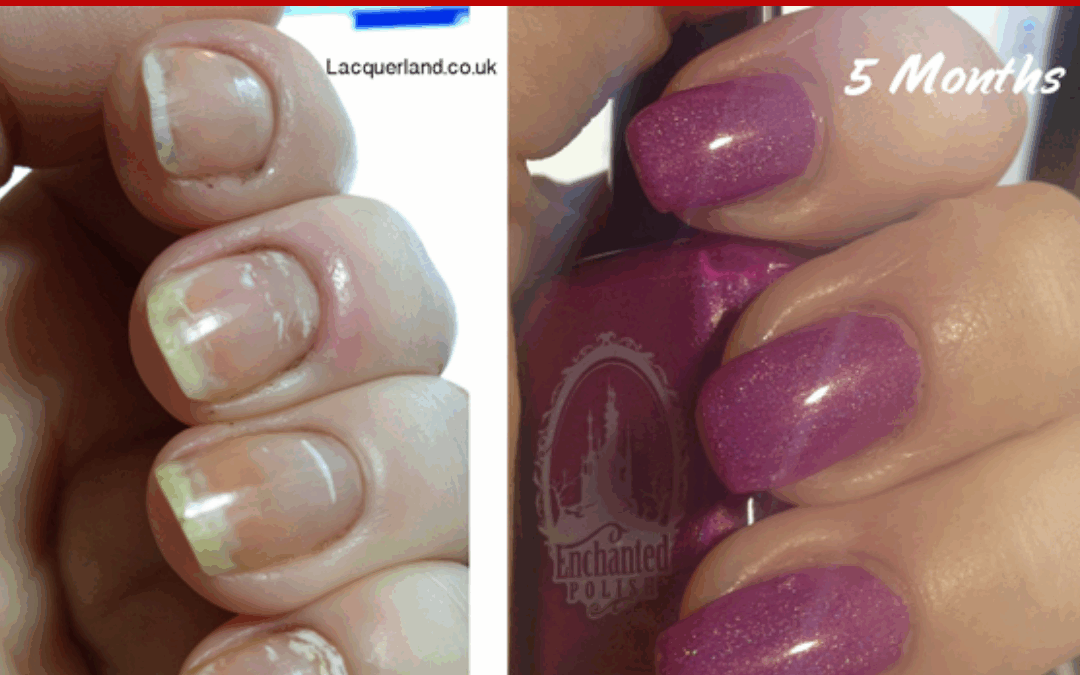 WHITE SPOTS IN NAILS – Sue’s Pure Nail Oil™ Challenge