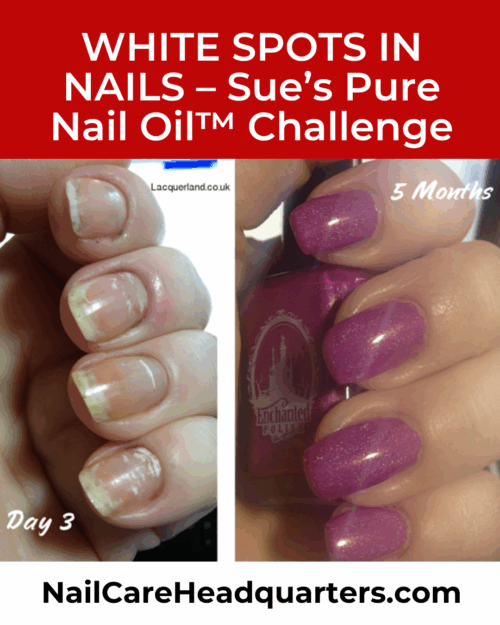 www.NailCareHQ.com White-spots-on-nails-5 month update