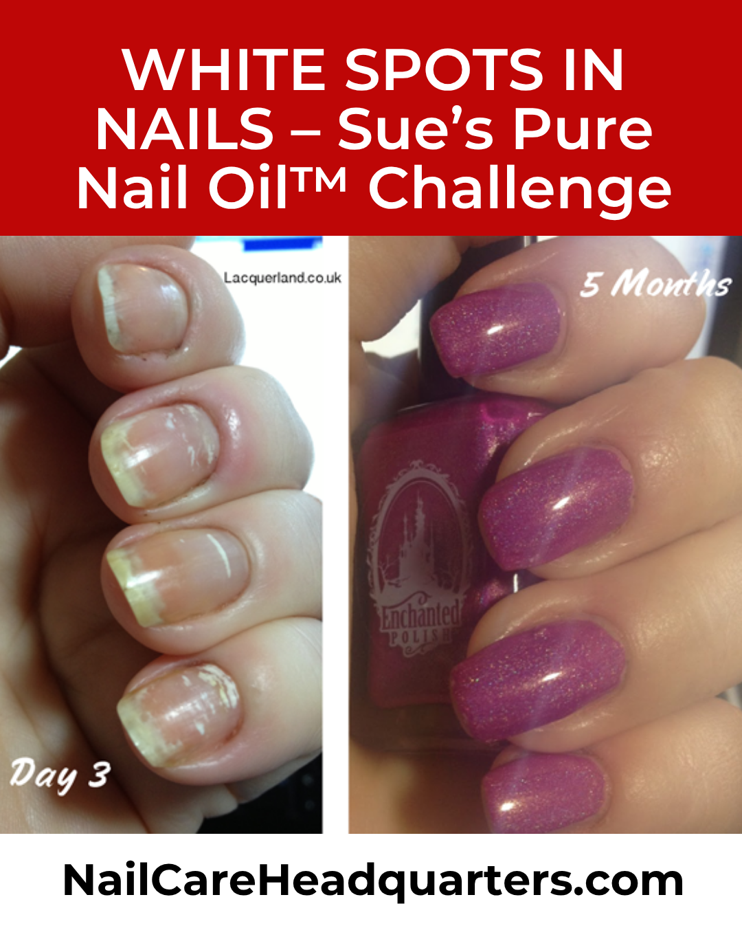 www.NailCareHQ.com White-spots-on-nails-5 month update
